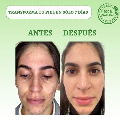 BIOAQUA SKIN™ - Di Adiós a las Imperfecciones y Recupera tu rostro